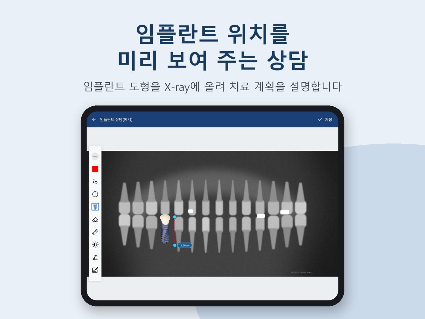 임플란트 위치를 표시한 치과 상담 앱 화면